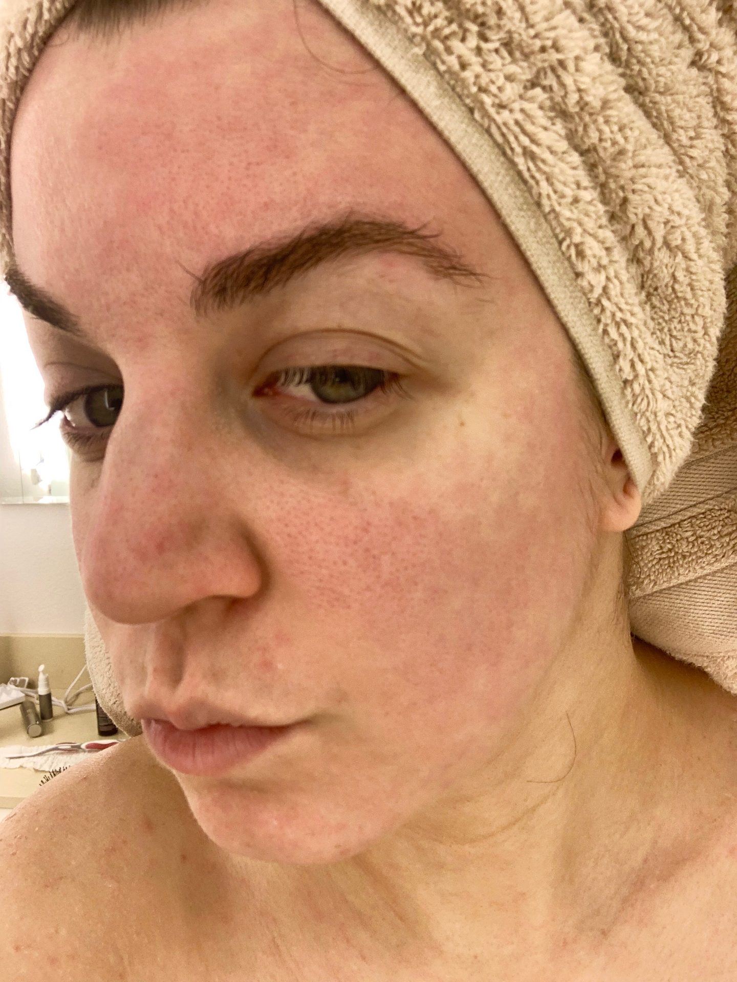 Acidity Rash My Acid Reflux Medication Gave Me An Autoimmune Disease – Dose of Bliss